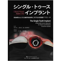 シングル・トゥースインプラント