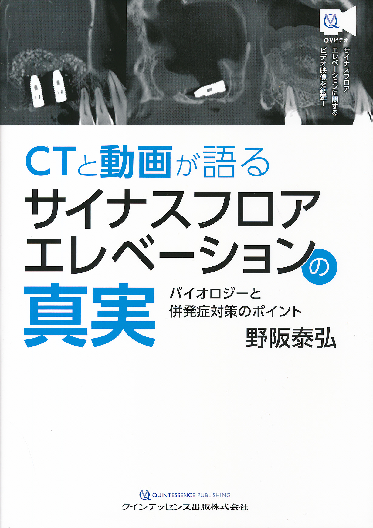 全てのアイテム CTと動画が語るサイナスフロアエレベーションの真実